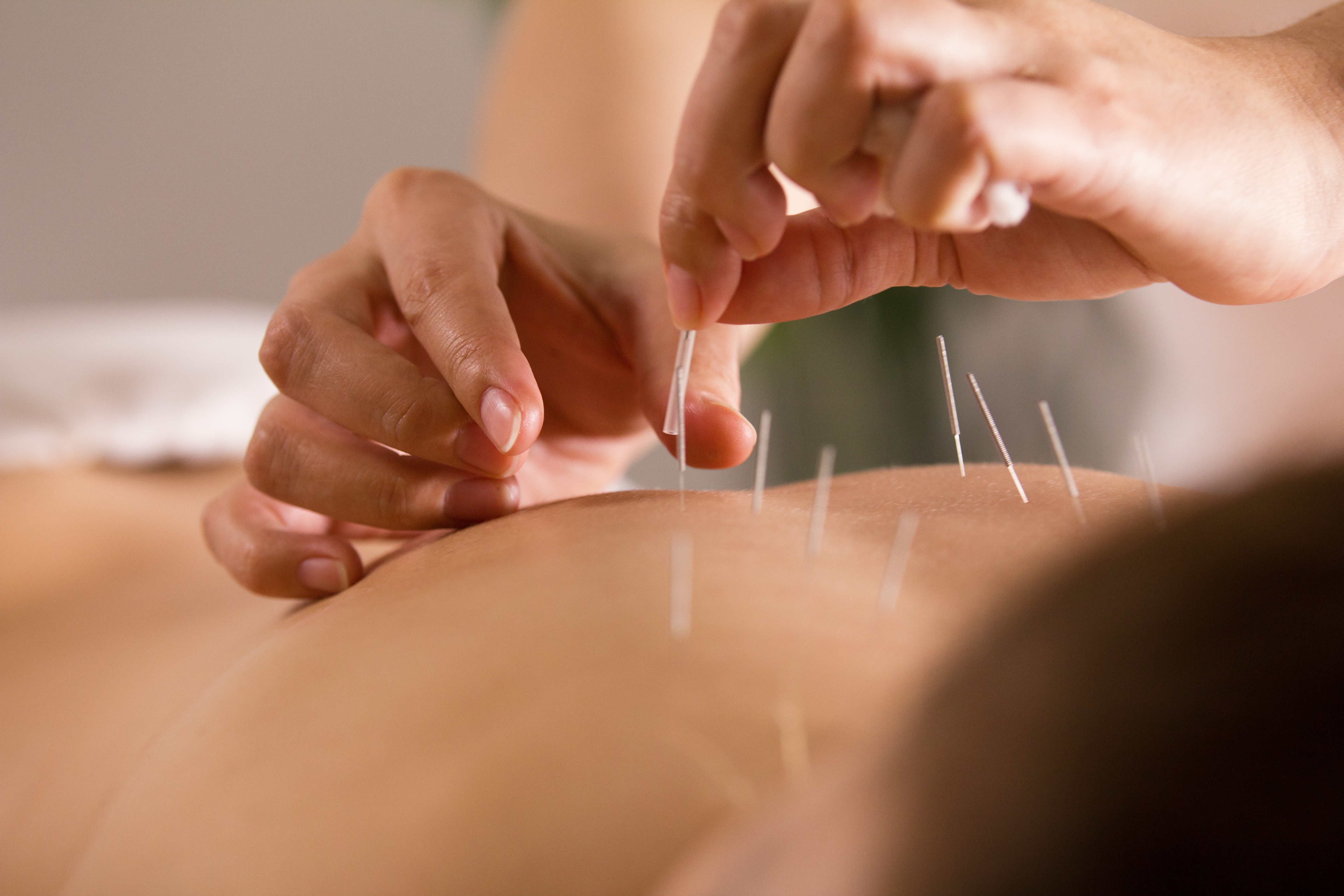 The doctor sticks needles into the woman’s body on the acupuncture – close up